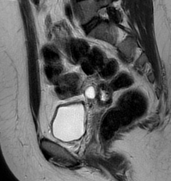 File:Broad ligament leiomyoma (Radiopaedia 81634-95516 Sagittal T2 12).jpg
