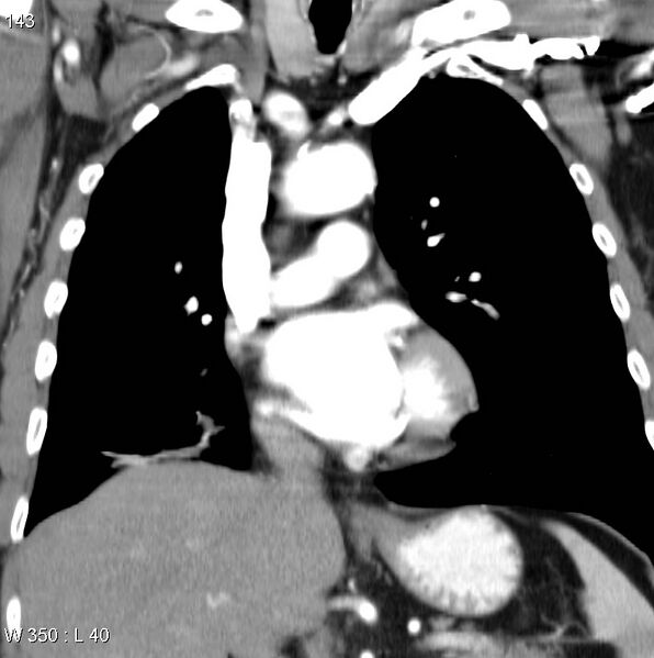 File:Bronchial carcinoid tumor with right lower lobe collapse (Radiopaedia 29060-29422 C 12).jpg