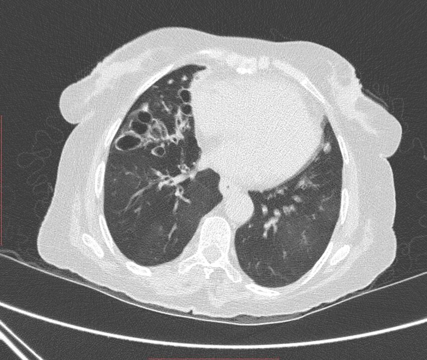 Bronchiectasis (Radiopaedia 72693-83293 Axial lung window 88).jpg