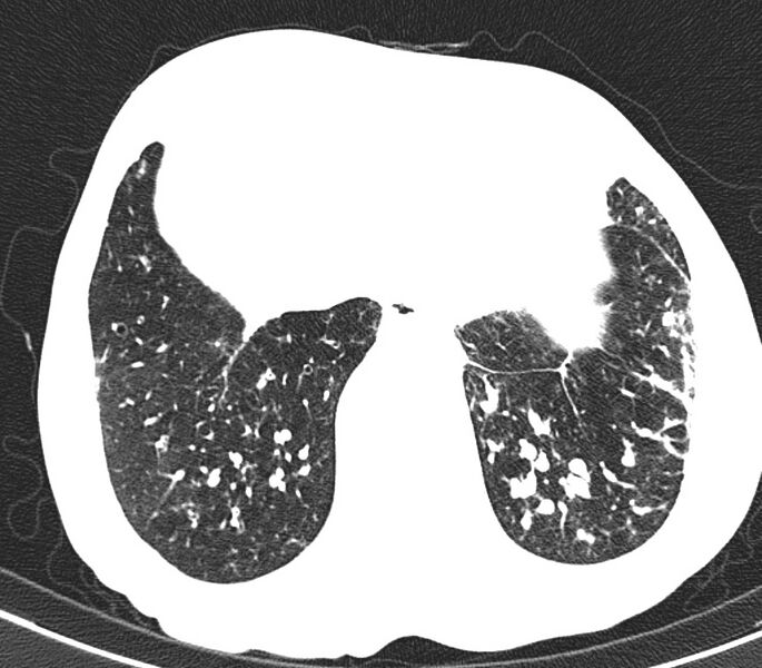 File:Bronchiolitis (Radiopaedia 24616-24887 Axial lung window 51).jpg