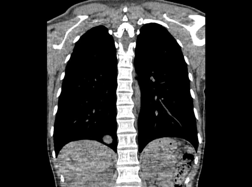 Bronchogenic cyst (Radiopaedia 80273-93615 D 78).jpg