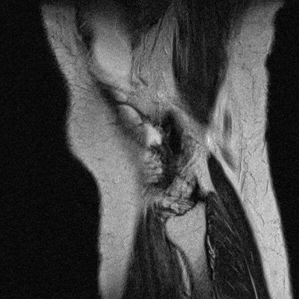 File:Bucket handle tear - medial meniscus (Radiopaedia 79028-91942 Sagittal T2 1).jpg