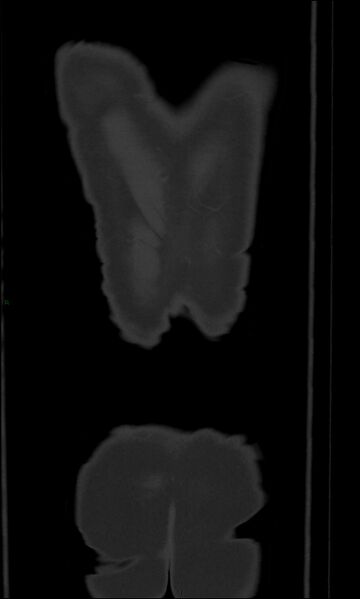 File:Burst fracture (Radiopaedia 83168-97542 Coronal bone window 73).jpg