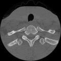 C5 facet fracture (Radiopaedia 58374-65499 Axial bone window 83).jpg