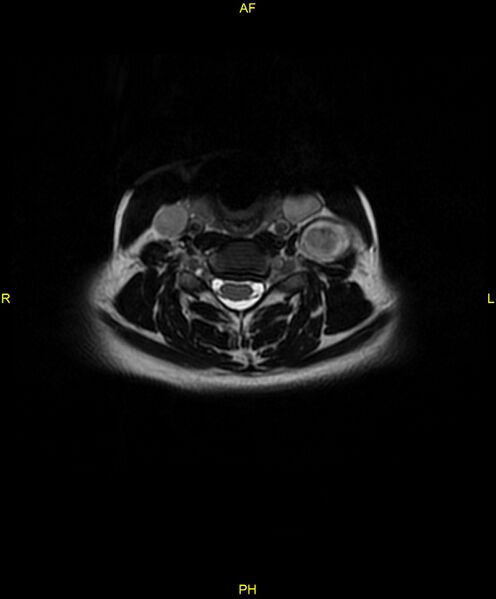 File:C5 nerve sheath tumor (Radiopaedia 85777-101596 Axial T2 40).jpg