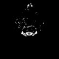 CNS lymphoma (Radiopaedia 73088-83796 Axial ADC 1).jpeg