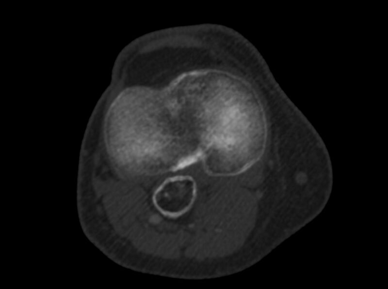 File:Calcified hematoma - popliteal fossa (Radiopaedia 63938-72763 C 34).jpg