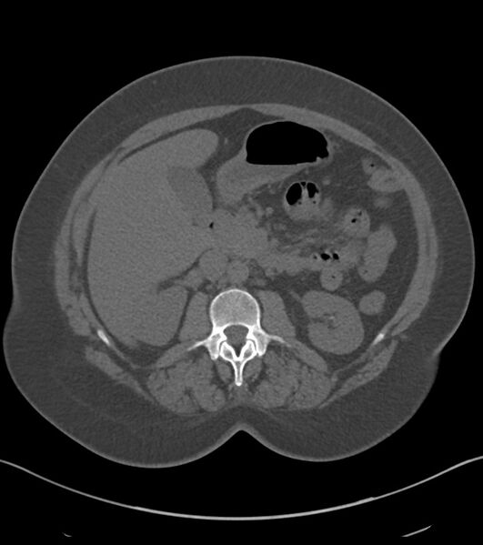 File:Calcified hepatic hydatid cyst (Radiopaedia 81127-94738 Axial non-contrast 40).jpg