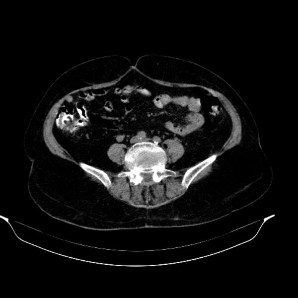 File:Calcified hydatid cyst (Radiopaedia 62000-70085 Axial non-contrast 72).jpg