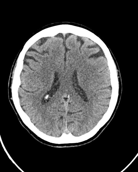 File:Calcified meningioma (Radiopaedia 74361-85243 Axial non-contrast 21).jpg