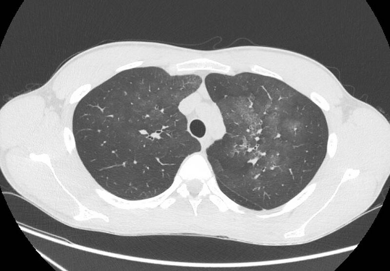 File:Cannabis-induced diffuse alveolar hemorrhage (Radiopaedia 89834-106946 Axial lung window 30).jpg