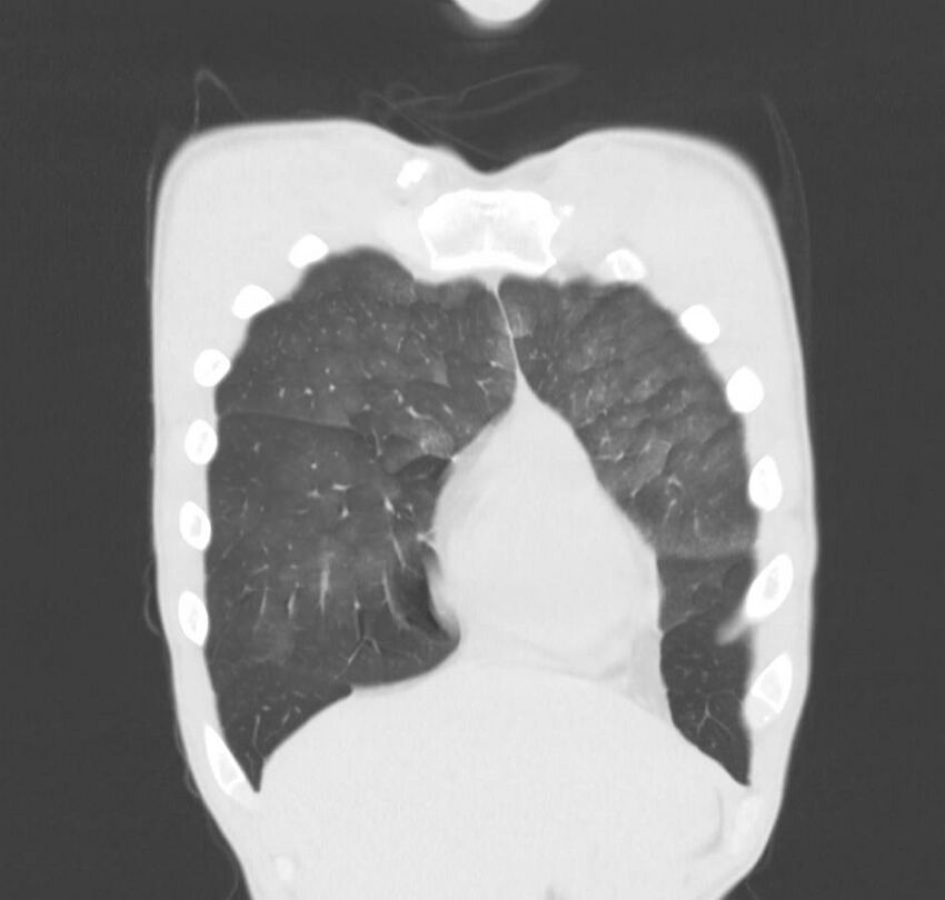 Cannabis-induced diffuse alveolar hemorrhage (Radiopaedia 89834-106946 Coronal lung window 75).jpg