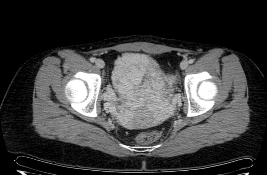 Cannonball metastases - uterine choriocarcinoma (Radiopaedia 70137-80174 A 38).jpg