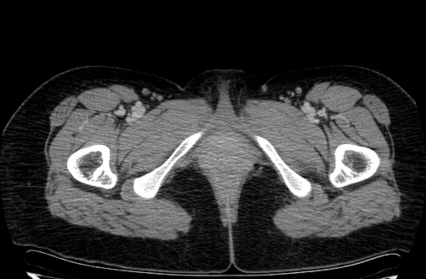 Cannonball metastases - uterine choriocarcinoma (Radiopaedia 70137-80174 A 77).jpg