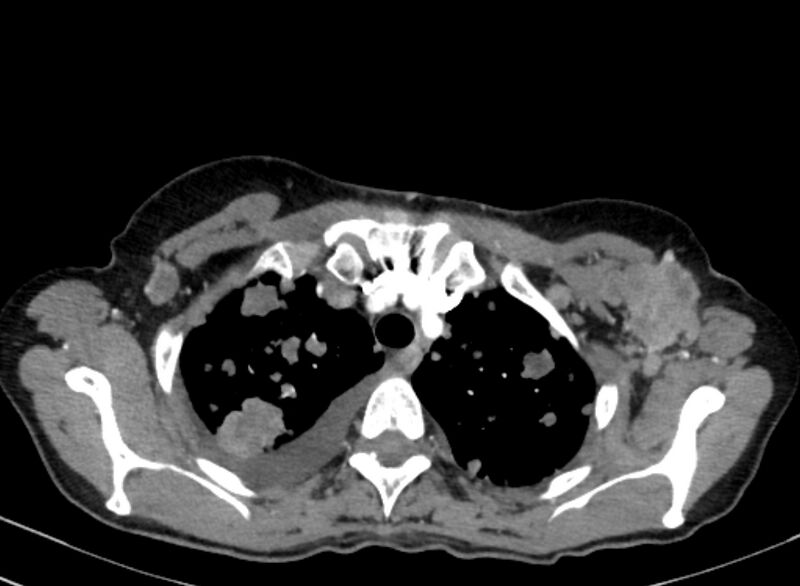 File:Cannonball metastases from breast cancer (Radiopaedia 91024-108569 A 28).jpg