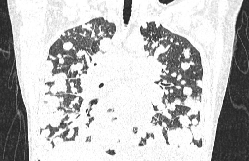 File:Cannonball metastases from breast cancer (Radiopaedia 91024-108569 Coronal lung window 75).jpg
