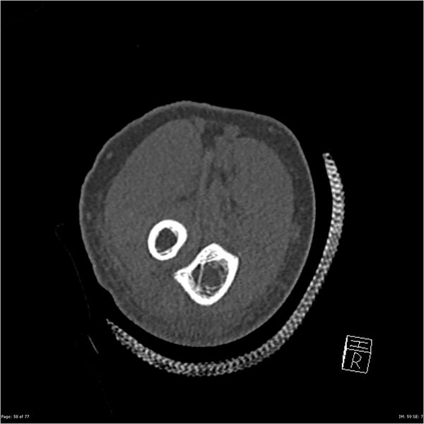 File:Capitellum fracture (Radiopaedia 23352-23426 Coronal bone window 58).jpg