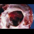 Cardiac myxoma (gross pathology) (Radiopaedia 9285).jpg