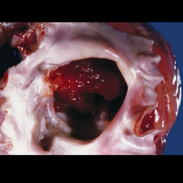 File:Cardiac myxoma (gross pathology) (Radiopaedia 9285).jpg