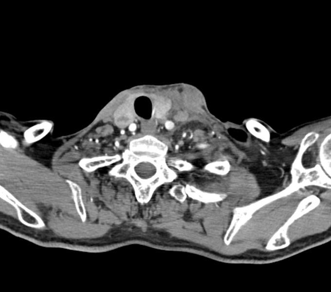 File:Carotid artery pseudoaneurysm (Radiopaedia 84030-99259 C 67).jpg