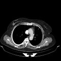Carotid body tumor (Radiopaedia 21021-20948 A 32).jpg
