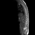 Caudal regression syndrome (Radiopaedia 61990-70072 Sagittal T1 9).jpg