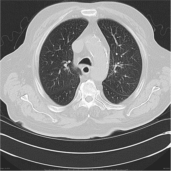 File:Cavitating left lower lobe lesion - squamous cell lung cancer (Radiopaedia 27749-28176 Axial lung window 15).jpg