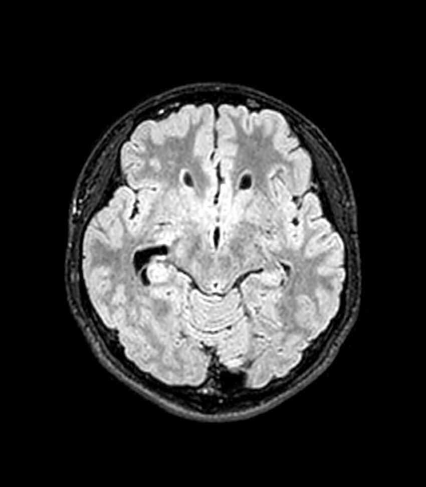Central neurocytoma (Radiopaedia 79320-92380 Axial FLAIR 184).jpg