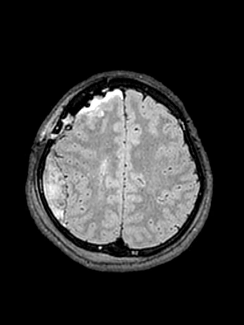 Central neurocytoma (Radiopaedia 79320-92381 Axial FLAIR 54).jpg