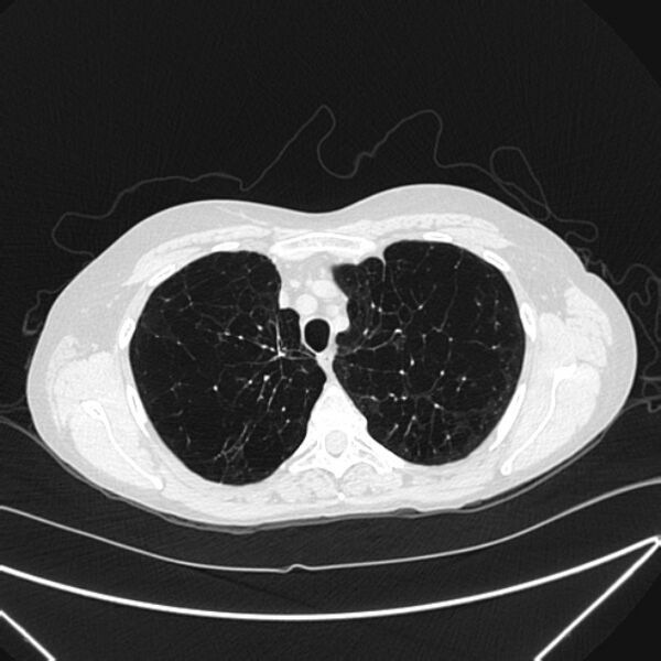 File:Centrilobular pulmonary emphysema (Radiopaedia 24495-24789 Axial lung window 21).jpg