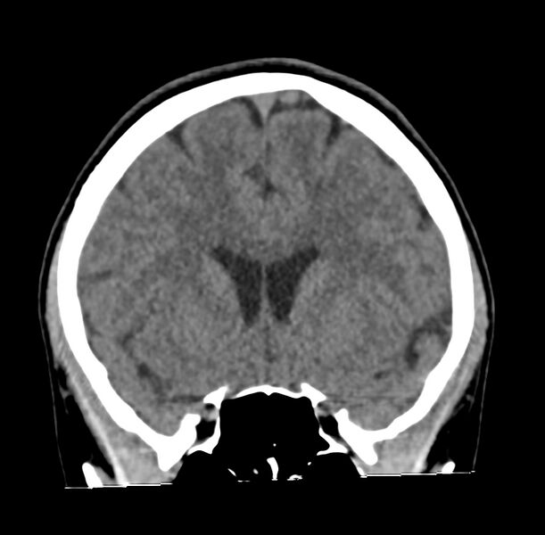 File:Cerebellar agenesis (Radiopaedia 30203-30817 Coronal non-contrast 10).jpg