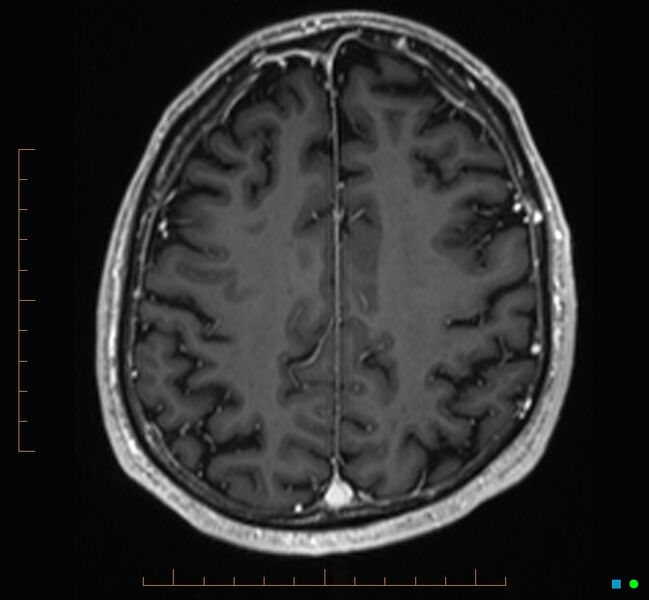 File:Cerebellar gangliocytoma (Radiopaedia 65377-74422 Axial T1 C+ 102).jpg
