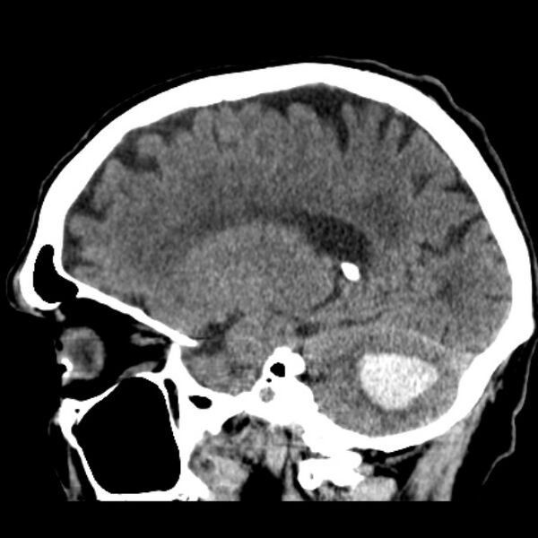 File:Cerebellar hemorrhage (Radiopaedia 27193-27359 C 29).jpg