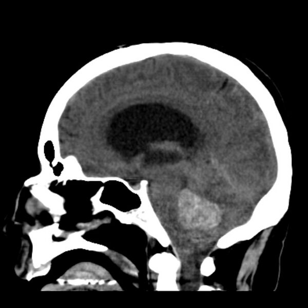 File:Cerebellar hemorrhage causing obstructive hydrocephalus (Radiopaedia 33989-35207 B 26).jpg