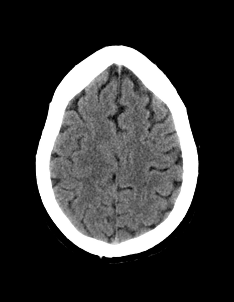 File:Cerebellar infarct due to vertebral artery dissection with posterior fossa decompression (Radiopaedia 82779-97030 Axial non-contrast 27).png
