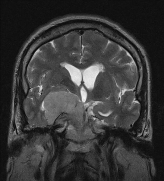 File:Cerebellopontine angle meningioma (Radiopaedia 24459-24764 Coronal T2 10).jpg
