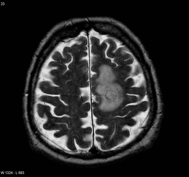 File:Cerebral absceses (Radiopaedia 4933-6838 Axial T2 1).jpg