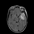Cerebral abscess post cardiac surgery (Radiopaedia 27244-27420 Axial FLAIR 10).jpg