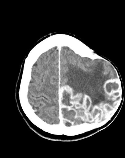 File:Cerebral abscesses (Radiopaedia 70458-80568 Axial Contrast 49).jpg
