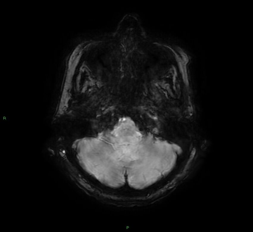 Cerebral amyloid angiopathy-associated lobar intracerebral hemorrhage (Radiopaedia 58378-65517 Axial SWI 14).jpg