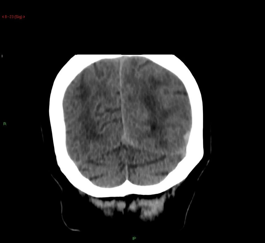 Cerebral amyloid angiopathy-associated lobar intracerebral hemorrhage (Radiopaedia 58378-65518 Coronal non-contrast 23).jpg