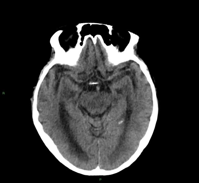 File:Cerebral amyloid angiopathy-associated lobar intracerebral hemorrhage (Radiopaedia 58530-65688 Axial non-contrast 31).jpg