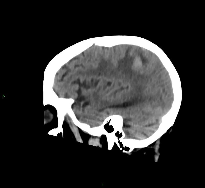 Cerebral amyloid angiopathy-associated lobar intracerebral hemorrhage (Radiopaedia 58530-65688 C 41).jpg