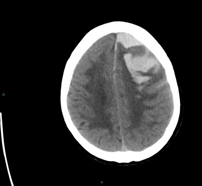 File:Cerebral amyloid angiopathy-associated lobar intracerebral hemorrhage (Radiopaedia 58561-65724 Axial non-contrast 13).jpg