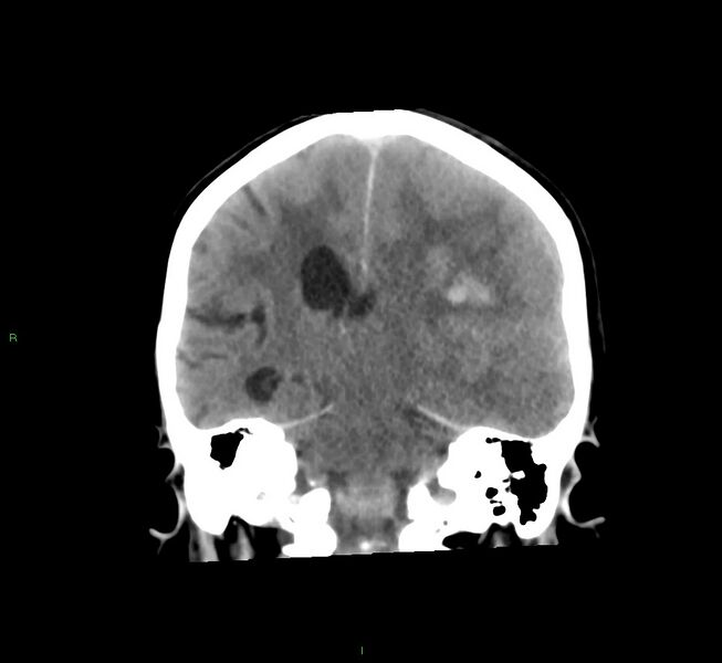 File:Cerebral amyloid angiopathy-associated lobar intracerebral hemorrhage (Radiopaedia 58561-65724 Coronal non-contrast 28).jpg