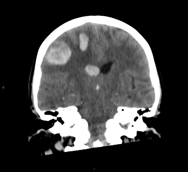 File:Cerebral amyloid angiopathy-associated lobar intracerebral hemorrhage (Radiopaedia 58566-65730 Coronal non-contrast 36).jpg