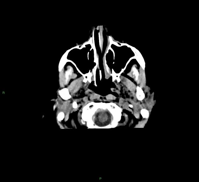 File:Cerebral amyloid angiopathy-associated lobar intracerebral hemorrhage (Radiopaedia 58751-65972 Axial non-contrast 47).jpg