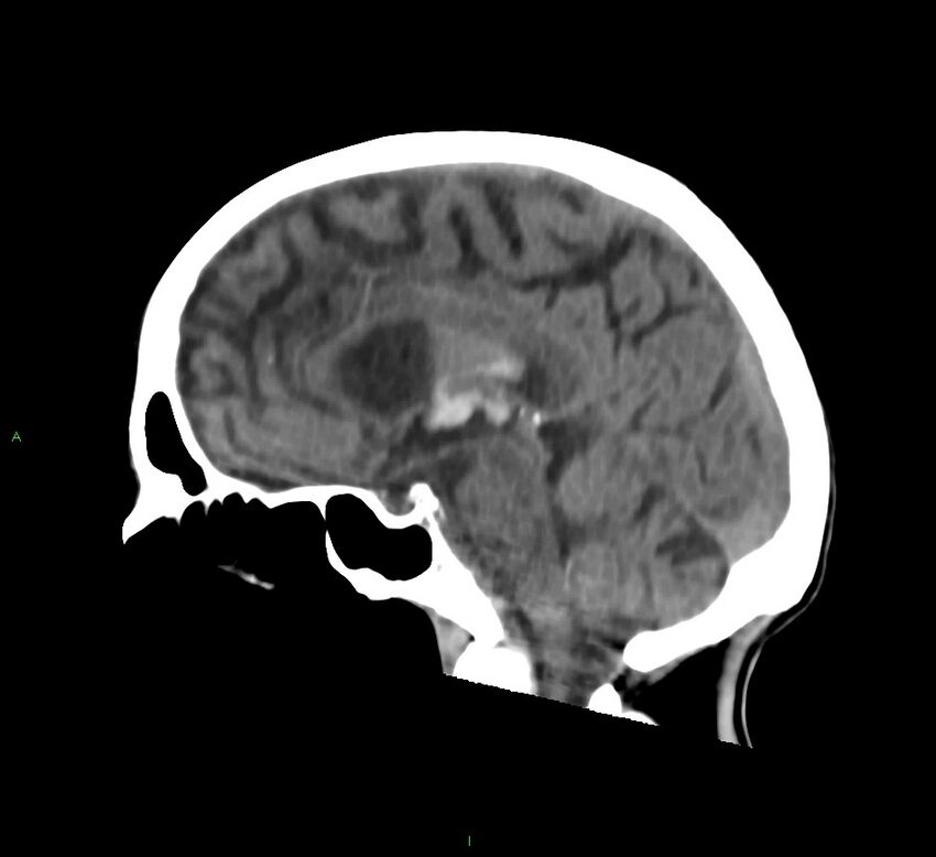 Cerebral amyloid angiopathy-associated lobar intracerebral hemorrhage (Radiopaedia 58758-65980 C 29).jpg