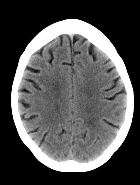 File:Cerebral aneurysm with rupture (Radiopaedia 29933-30457 Axial non-contrast 18).jpg