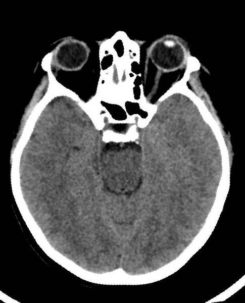 File:Cerebral edema due to severe hyponatremia (Radiopaedia 89826-106938 Axial non-contrast 40).jpg